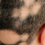 All You Need To Know About Alopecia