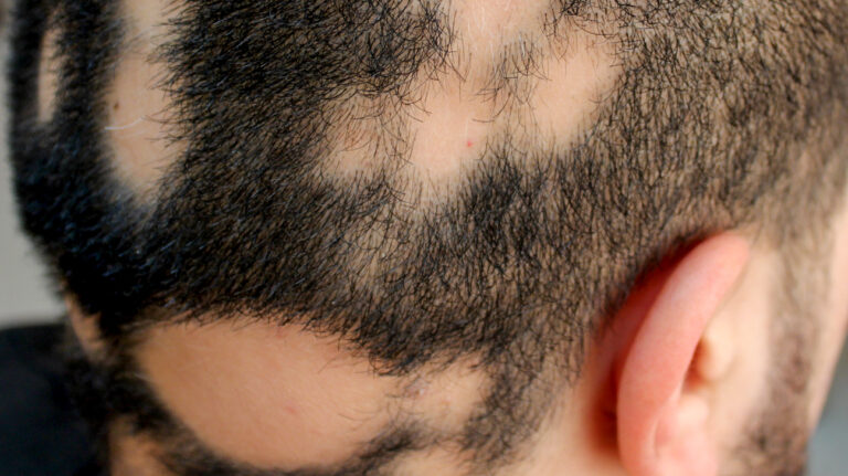 All You Need To Know About Alopecia